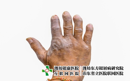 掌跖脓疱性银屑病：了解症状，治疗方法及预防措施