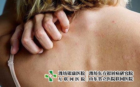 副银屑病初期什么典型症状？