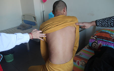 牛皮癣常见的发病原因有哪些：