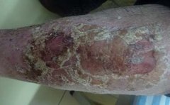 秋季中老年牛皮癣患者如何护理