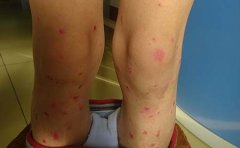 女性牛皮癣患者什么时候怀孕比较可以