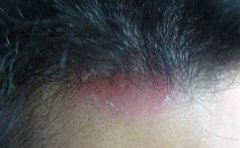 如何远离牛皮癣的危害呢