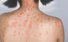 女性银屑病急性期有什么特点