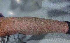 夏季来临牛皮癣谨防蚊虫叮咬