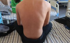 细说各类型牛皮癣危害