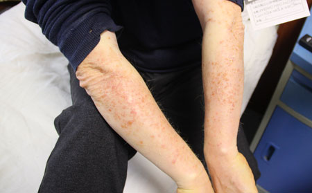 牛皮癣的发病原因