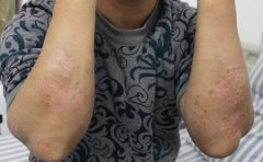 如果牛皮癣久病则易发关节炎