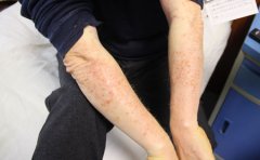 牛皮癣这六个不你知道吗?