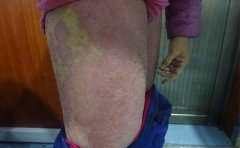 牛皮癣医院介绍什么是牛皮癣同行反应