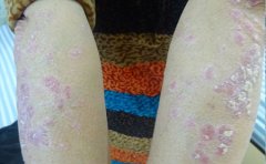 临沂治牛皮癣的价格是多少