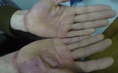 牛皮癣合理、正规的治疗方案