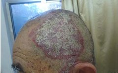 银屑病_临沂可以的银屑病治疗医院?老人银屑病的危害与治疗?