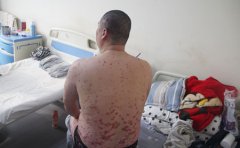 牛皮藓放任不管不治会怎样