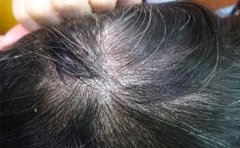 治可以近40年的牛皮癣  蒋家老太终于享受安稳晚年