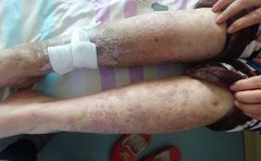 25岁花季女孩却被牛皮癣纠结13年