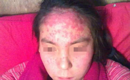 牛皮癣如何引起 牛皮癣为什么会出现 如何治疗牛皮癣