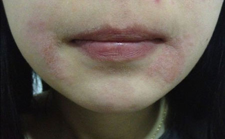 女性牛皮癣治疗