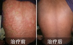 牛皮癣越来越“年轻化” 究竟是什么动了我们的青春岁月