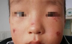 6岁儿童患上牛皮癣  用药无效病情加重怎么办