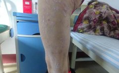 牛皮癣患病人群倾向“白领”?为何如何年轻化