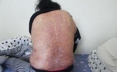 牛皮癣患者的色素沉着是如何产生的