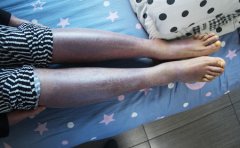 女性牛皮癣患者手脚冰凉原因大揭秘
