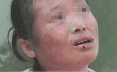 治疗银屑病分析银屑病能不能治可以