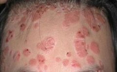 感冒也可能是诱发牛皮癣病因之一