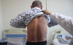 银屑病发病的相关原因探究