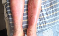 牛皮癣治疗找准病因是关键