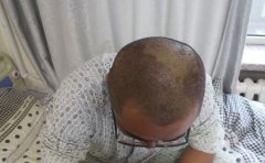 中医解析牛皮癣的病因