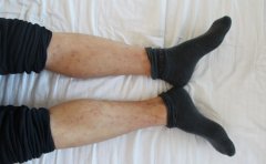 银屑病病因的确切因素