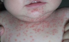 患者找出银屑病病因可使治疗变容易