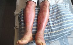 哪些误区容易导致银屑病的反复发作