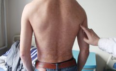 诱发银屑病的主要方面有哪些