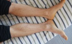 牛皮癣的症状特点
