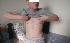 牛皮癣的基本症状有什么具体表现？