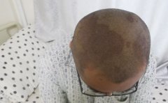 头部牛皮癣患者如何护理可以
