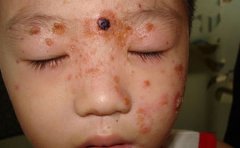 银屑病头部以及指甲病症特点表现