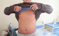 牛皮癣都有什么初期症状表现-临沂如何治疗牛皮癣