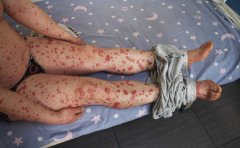 腿上有牛皮癣有什么表现