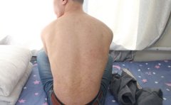 夏季银屑病临床特点有哪些