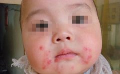 儿童白疕症状表现及护理方法