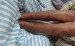 银屑病的四种类型症状统一介绍