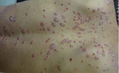 银屑病治疗的缓解表现有什么？