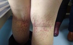 治疗牛皮癣哪里 可以