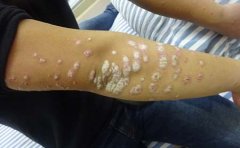 如何及时治疗外伤性牛皮癣？