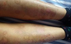 女性银屑病秋季护理方法攻略