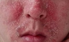 牛皮癣危害大您了解吗