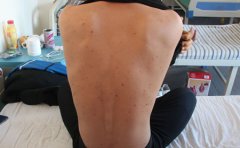 几种银屑病症状的危害表现